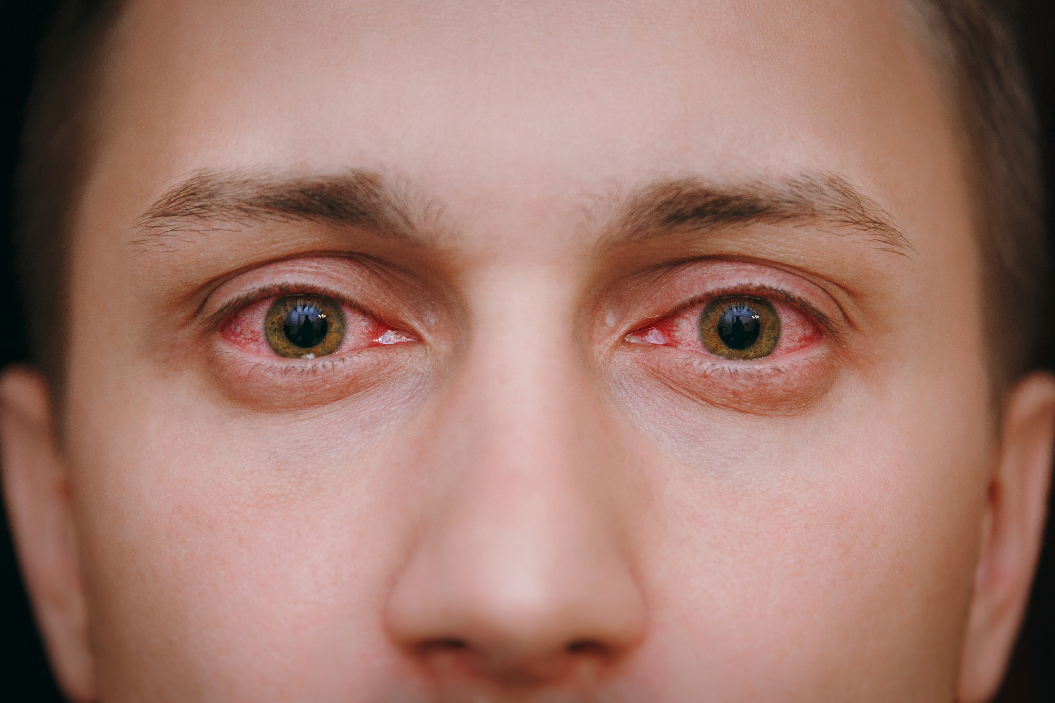 Close Up Of Two Annoyed Red Blood Eyes Of A Man Affected By